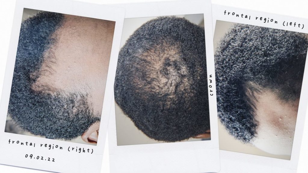thinning hair challenge_ how it started vs. how it's going _images