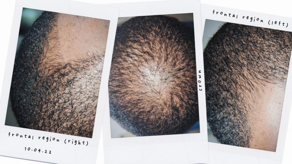 Hair growth challenge - starting over with Sydney Nicole Products, Men's Organic Growth Oil
thinning hair challenge_ how it started vs. how it's going _images